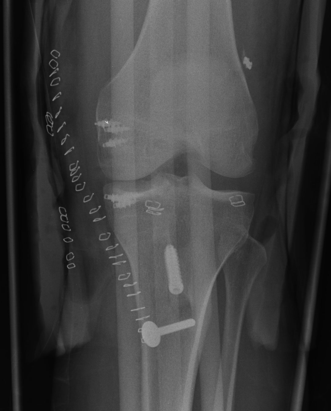 Knee Dislocation ACL PCL MCL Reconstruction AP